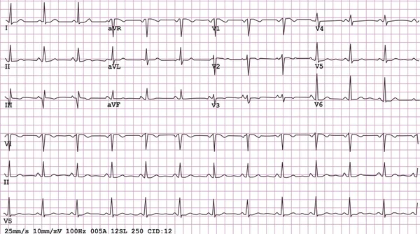 Electrocardiograma de 12 derivaciones