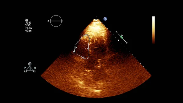 Ecocardiograma con Dobutamina